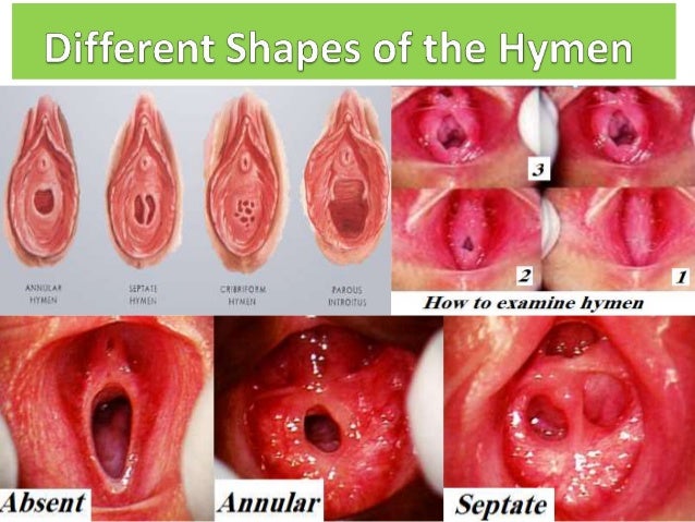 Hymen pic before and after sex gallery dunes